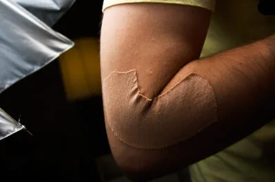 Lesões Agudas: Tecarterapia e Kinesio Taping